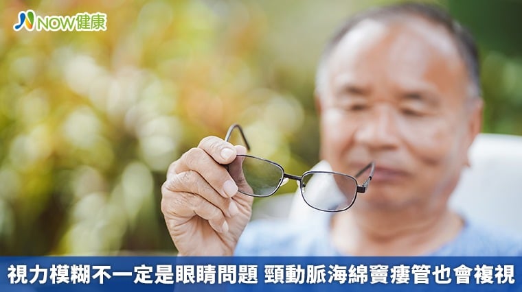 視力模糊不一定是眼睛問題 頸動脈海綿竇瘻管也會複視