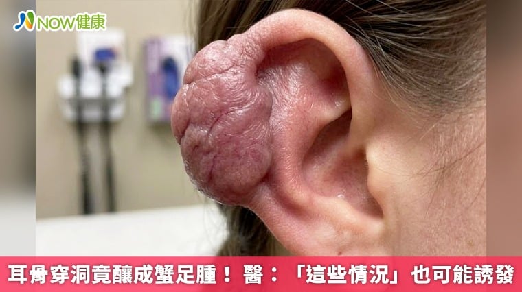 耳骨穿洞竟釀成蟹足腫！ 醫：「這些情況」也可能誘發