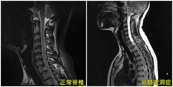 正常脊椎與脊髓空洞症的核磁共振影像比較。（圖／亞大醫院提供）
