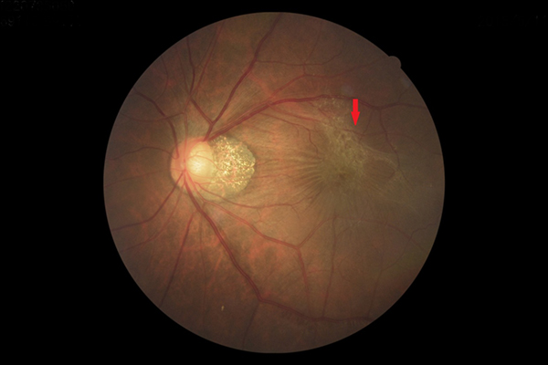 眼底檢查可見到明顯的纖維增生膜（紅色箭頭）拉扯黃斑部。（圖／王元聖醫師提供）