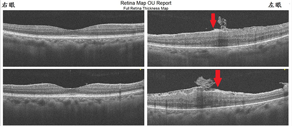 光學同調斷層掃描儀（OCT）檢查下，相對於右眼正常的黃斑部，左眼可見到黃斑部表面多了一層纖維增生膜（紅色箭頭）。（圖／王元聖醫師提供）