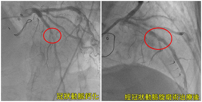 冠狀動脈旋磨術治療前後比較。(圖/亞洲大學附屬醫院提供) 冠狀動脈旋磨術治療前後比較。(圖/亞洲大學附屬醫院提供)