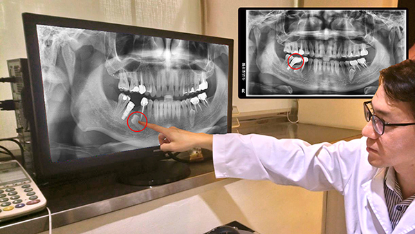 左邊X光片為避開多生牙植入植體，右邊X光片為依照植體位置，打造專屬假牙。（圖／林顯書醫師提供）