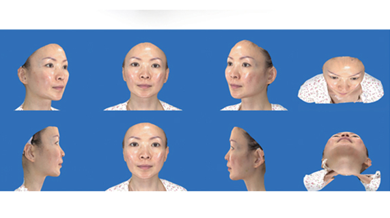 術前運用VECTRA 3D術前影像模擬系統，參考拉皮術後可能呈現的樣態。（圖／東京風采整形外科診所提供）