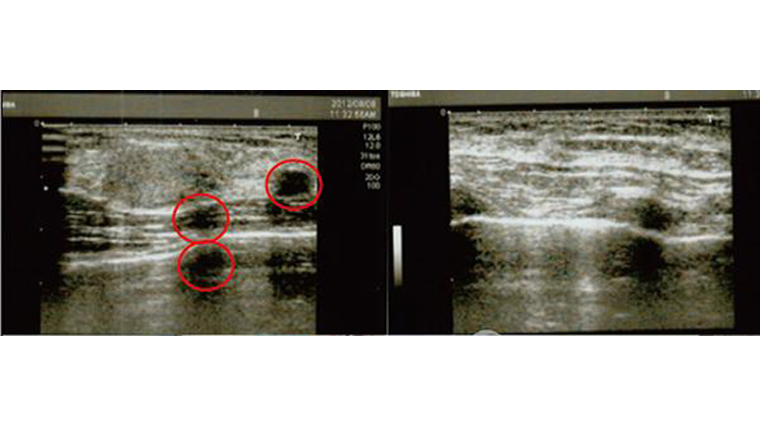 患者經超音波照射後，顯示出自體脂肪隆乳的乳房內有酸化的脂肪（紅色圓圈處）。（圖／東京風采整形外科診所提供）