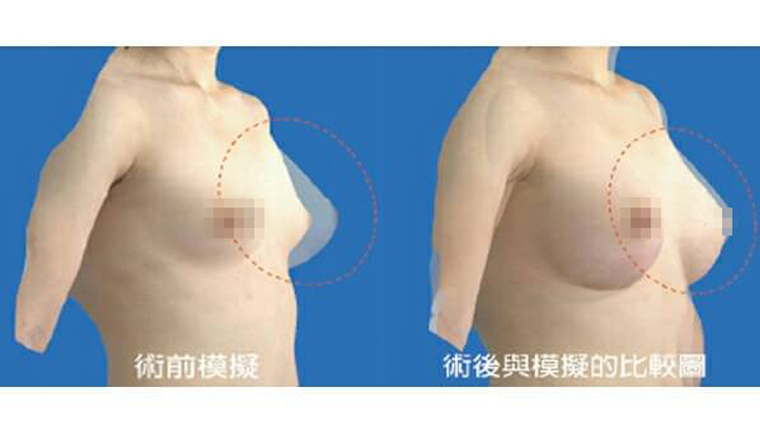 經VECTRA 3D術前影像模擬系統模擬出來的隆乳術前及術後比較圖。（圖／東京風采整形外科診所提供）