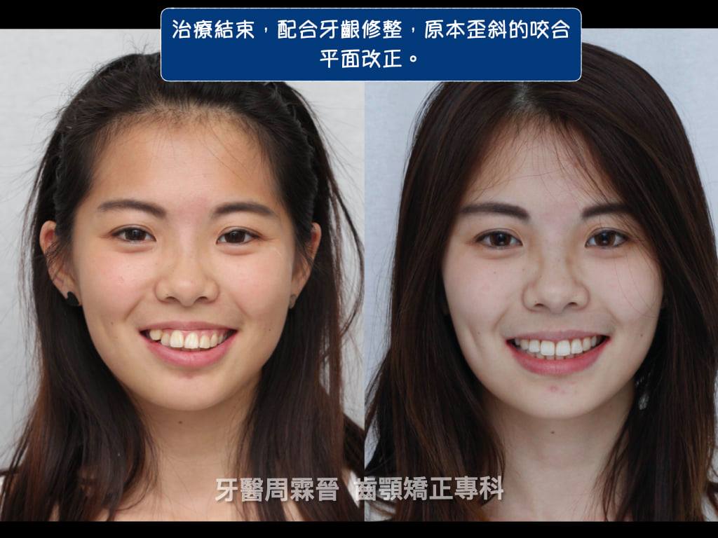 案例分享『19』--- 骨性暴牙x笑齦x小下巴 | 隱適美齒顎矯正專科 周霖晉醫師 | 台灣醫級邦-NOW健康