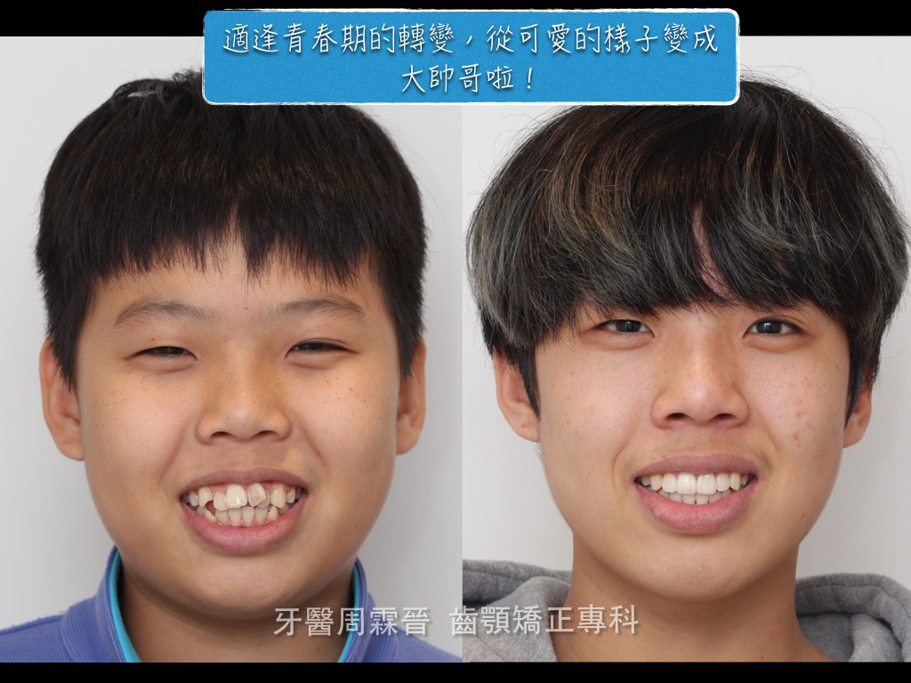 案例分享『19』--- 骨性暴牙x笑齦x小下巴 | 隱適美齒顎矯正專科 周霖晉醫師 | 台灣醫級邦-NOW健康