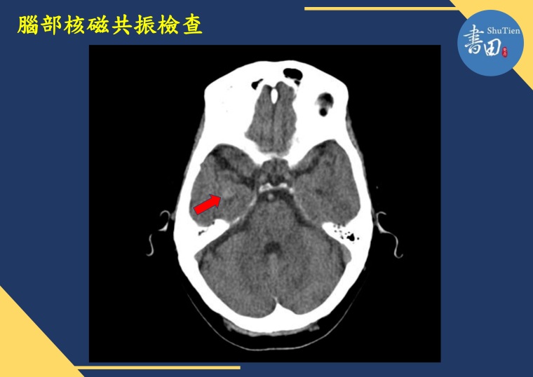▼在患者右側大腦有異常放電現象，進一步核磁共振檢查，證實右側大腦額葉有纖維化病變。（圖／書田診所提供）